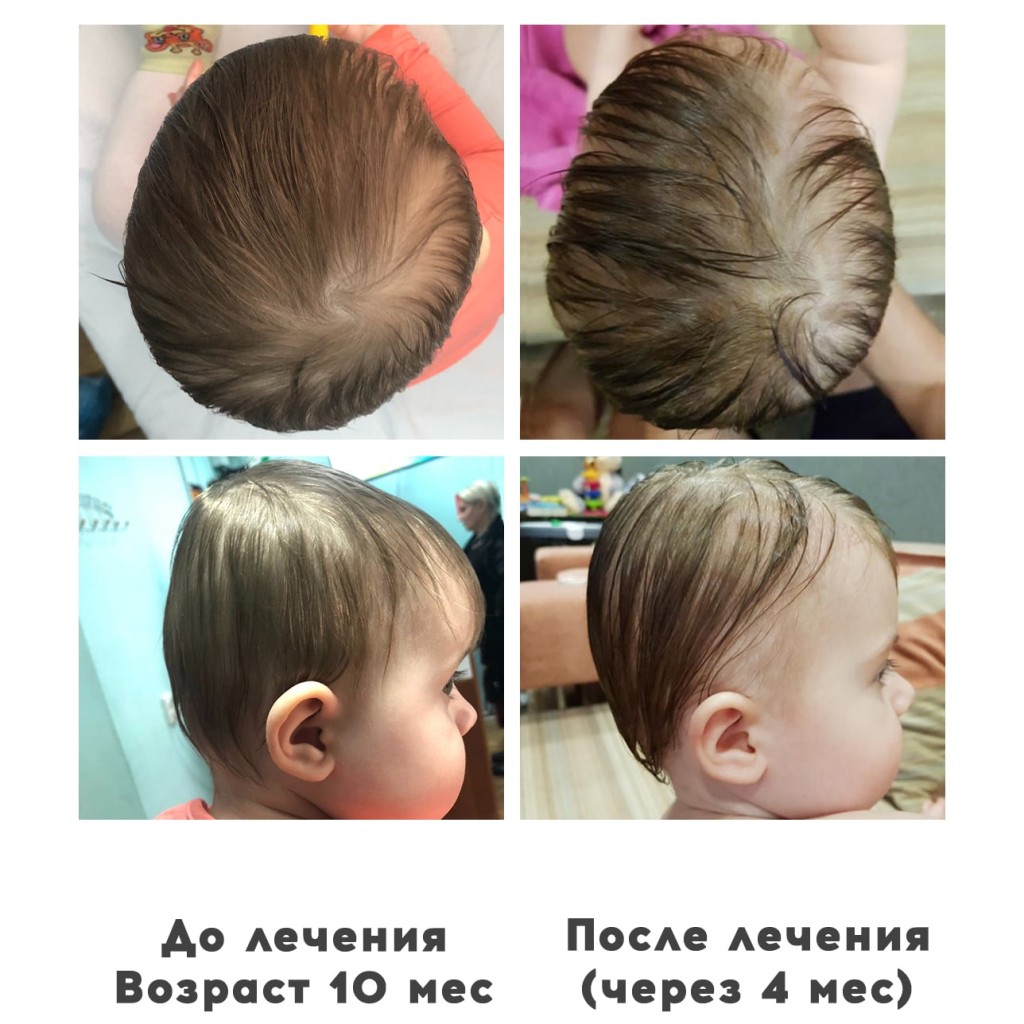 Прием ортопедов деформация головы у ребенка 0 - Ортотис Премиум