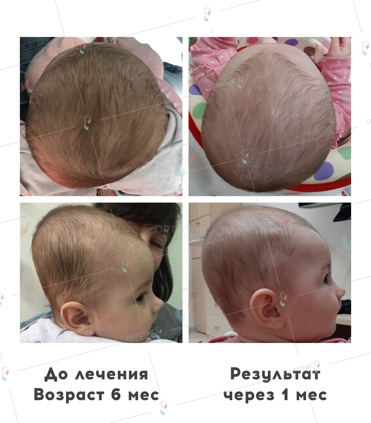 Плагиоцефалия, 4 месяцев - Ортотис Премиум