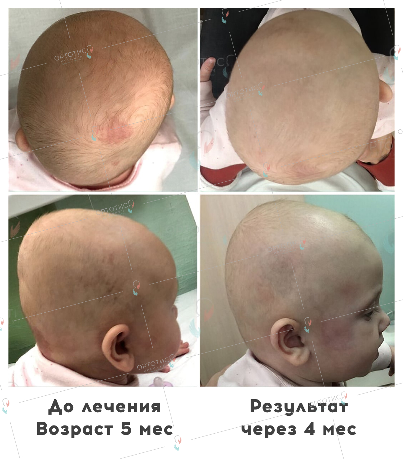 Плагиоцефалия, 4 месяцев - Ортотис Премиум