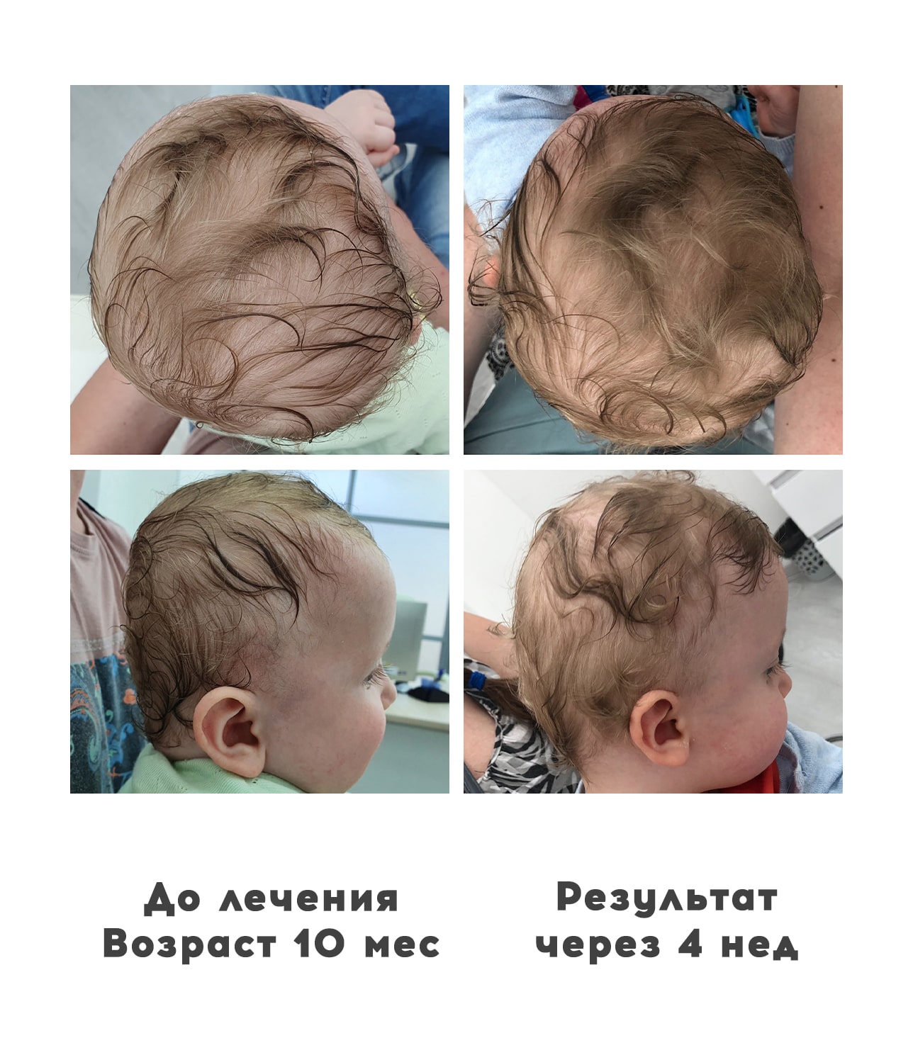 Прием ортопедов деформация головы у детей 8 - Ортотис Премиум