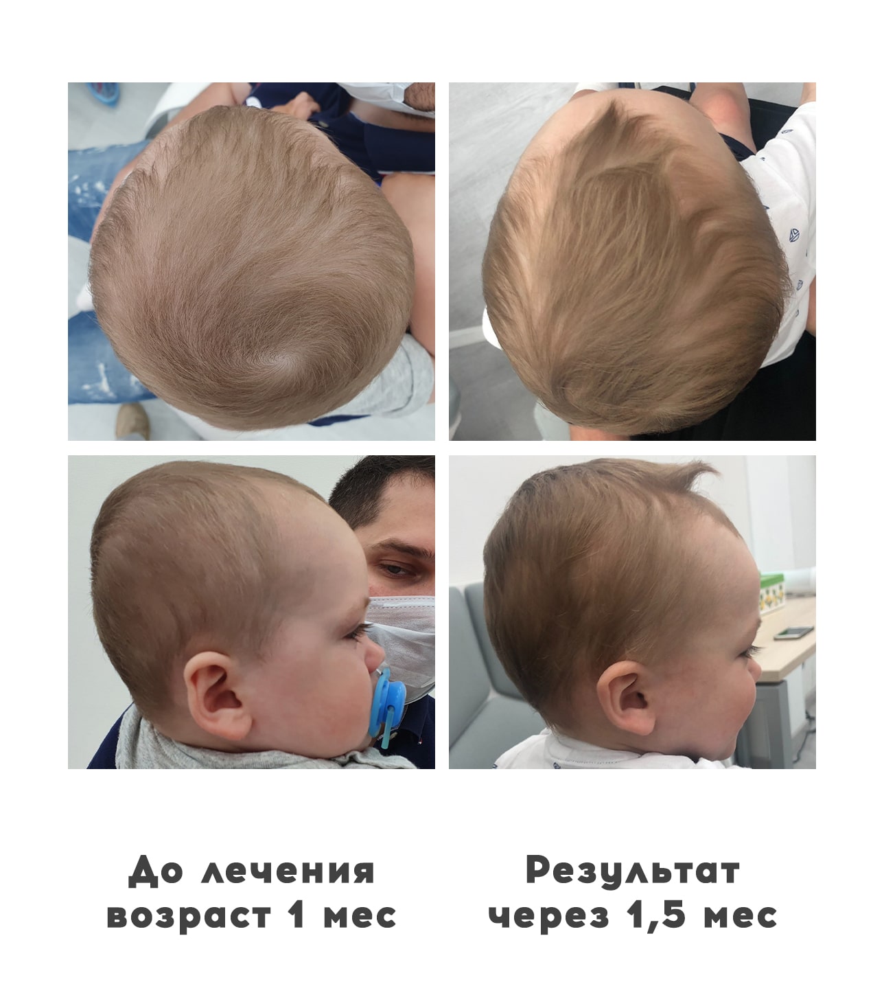 Прием ортопедов деформация головы у детей 15 - Ортотис Премиум