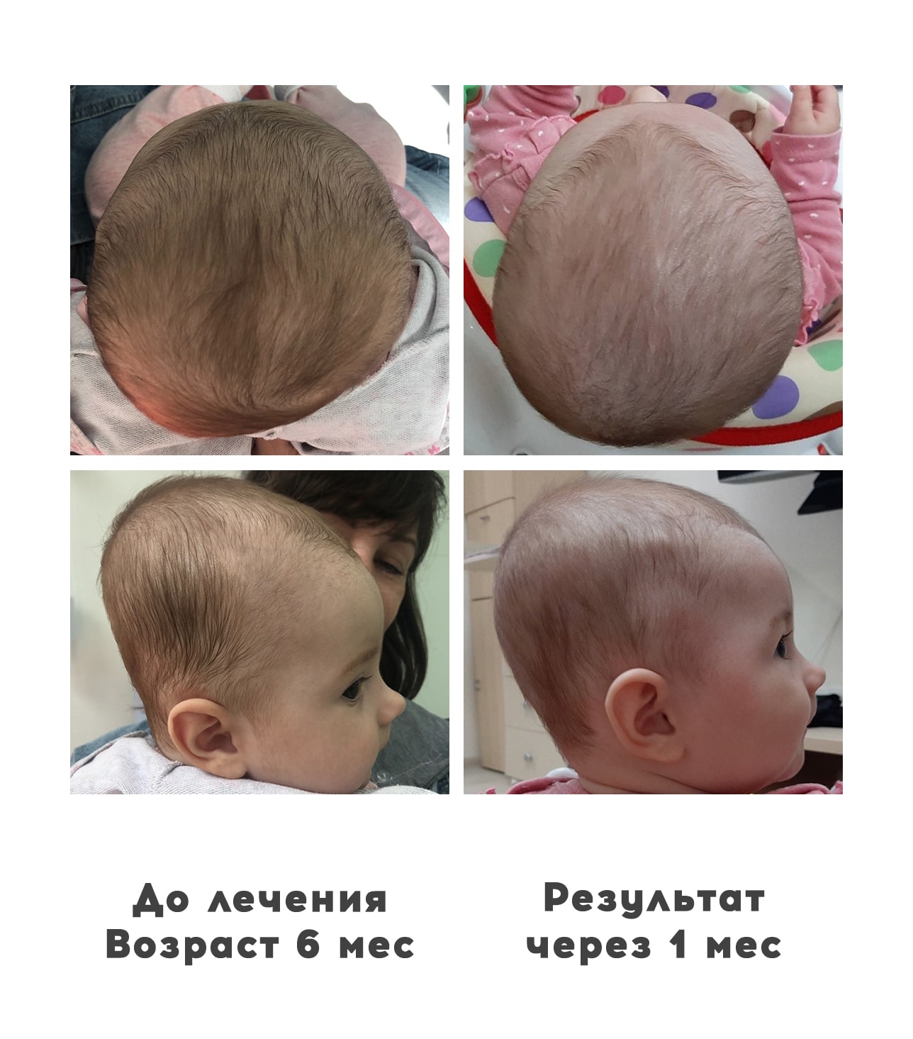Прием ортопедов деформация головы у детей 1 - Ортотис Премиум