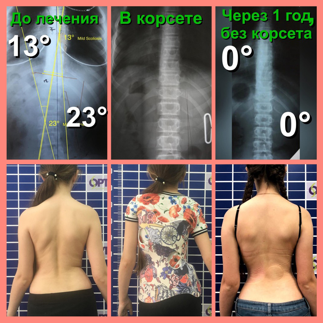 Искривление 30 градусов фото