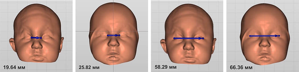 После голова три. Тригоноцефалия плагиоцефалия. Синостоз метопического шва тригоноцефалия у ребенка. Краниостеноз тригоноцефалия операция. Тригоноцефалия у ребенка операция.