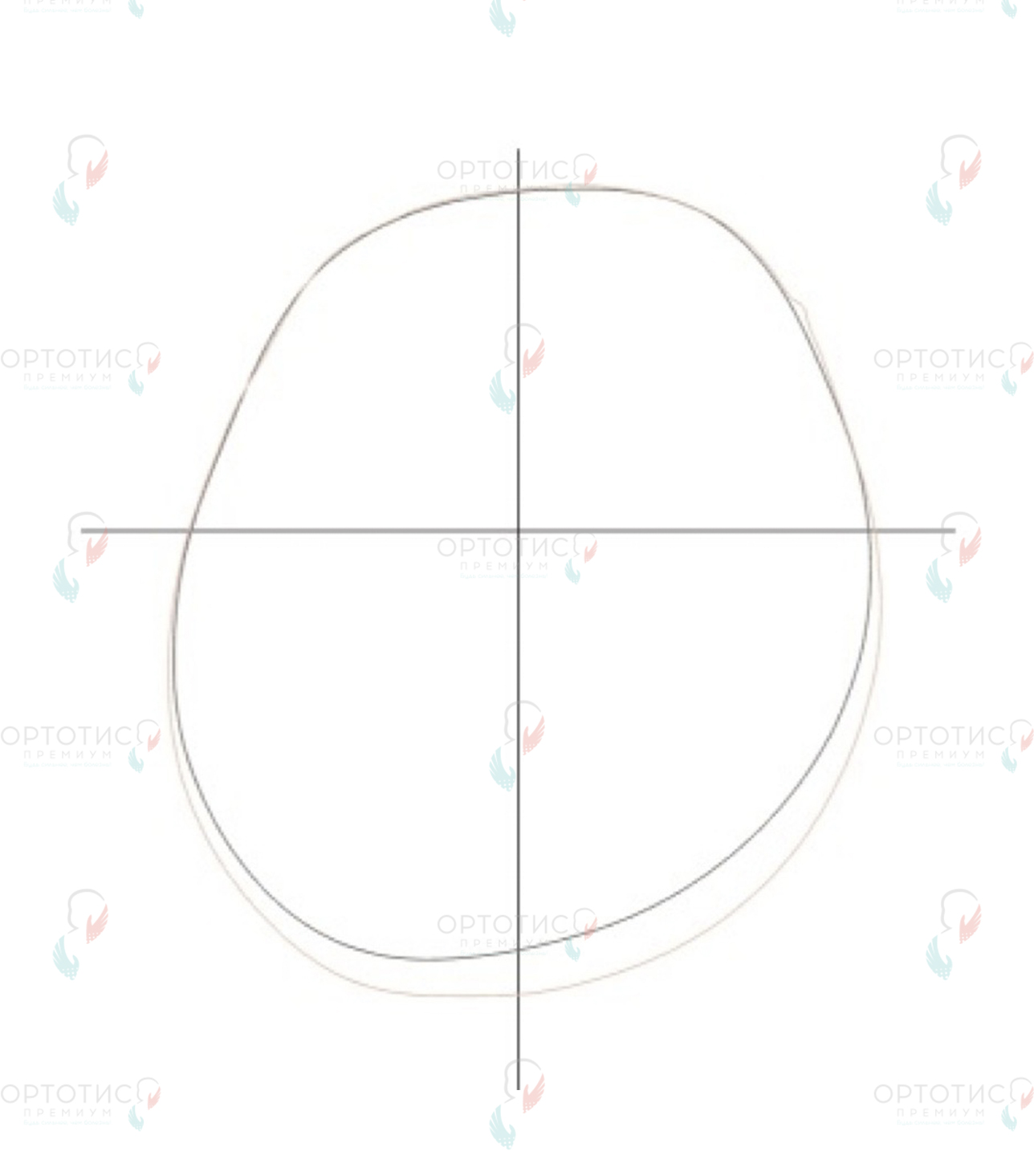 Позиционная асимметричная брахицефалия, 1,5 месяца - Ортотис Премиум