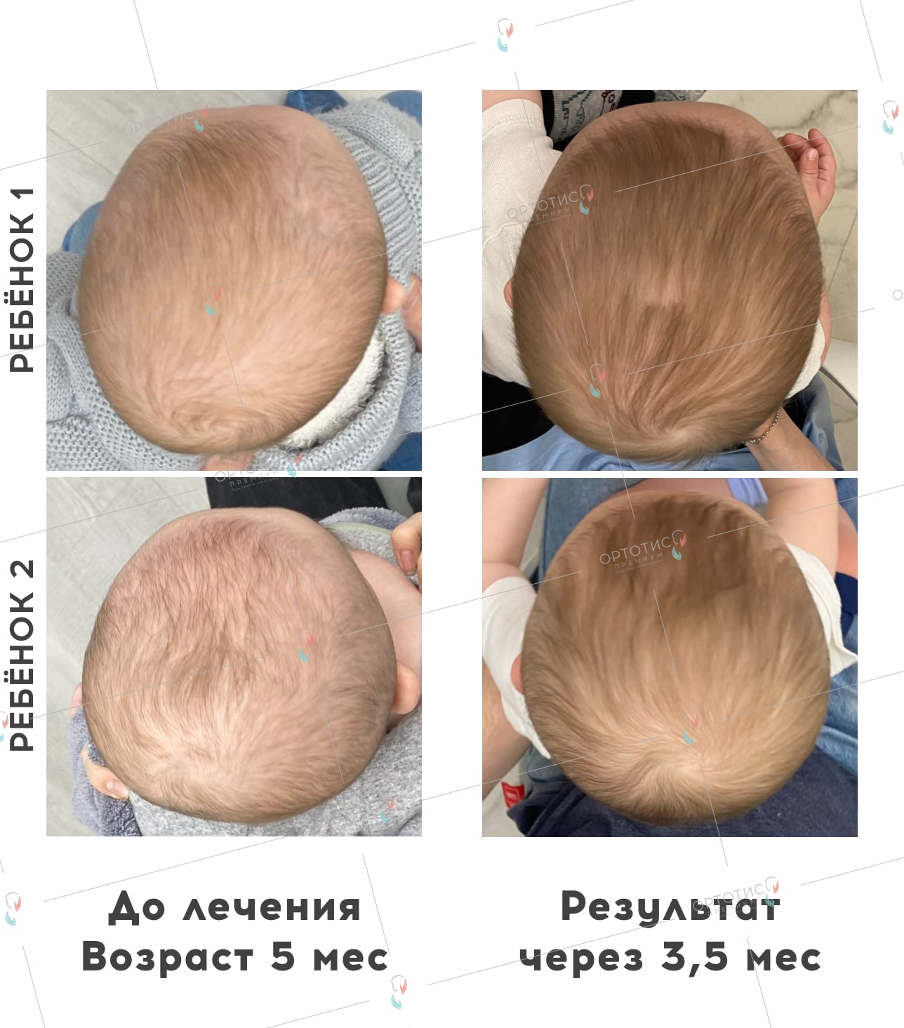 Ребенок 1 - Плагиоцефалия <br> Ребенок 2 - Брахицефалия, 3,5 месяца - Ортотис Премиум