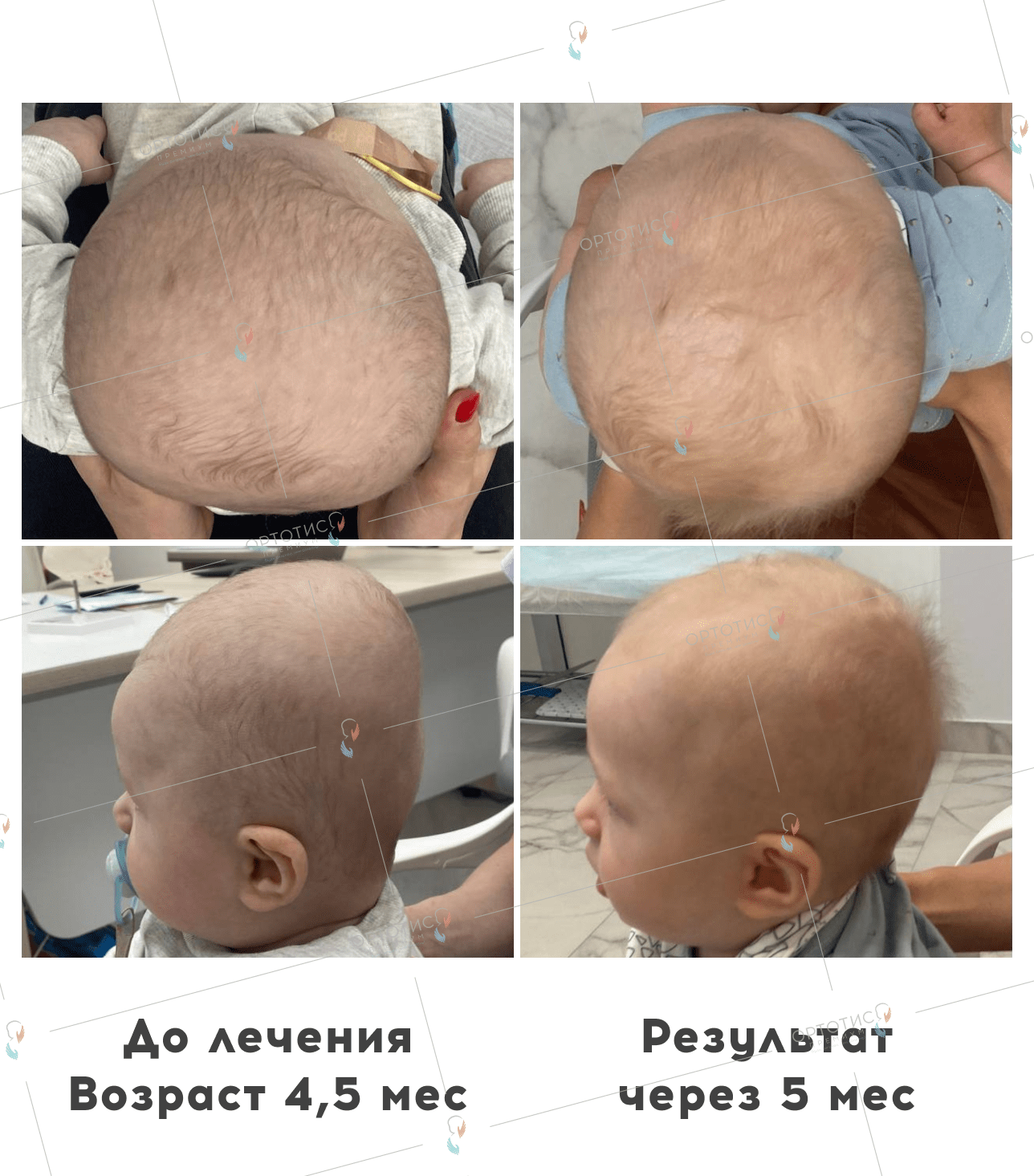 Асимметричная брахицефалия, 5 месяцев - Ортотис Премиум