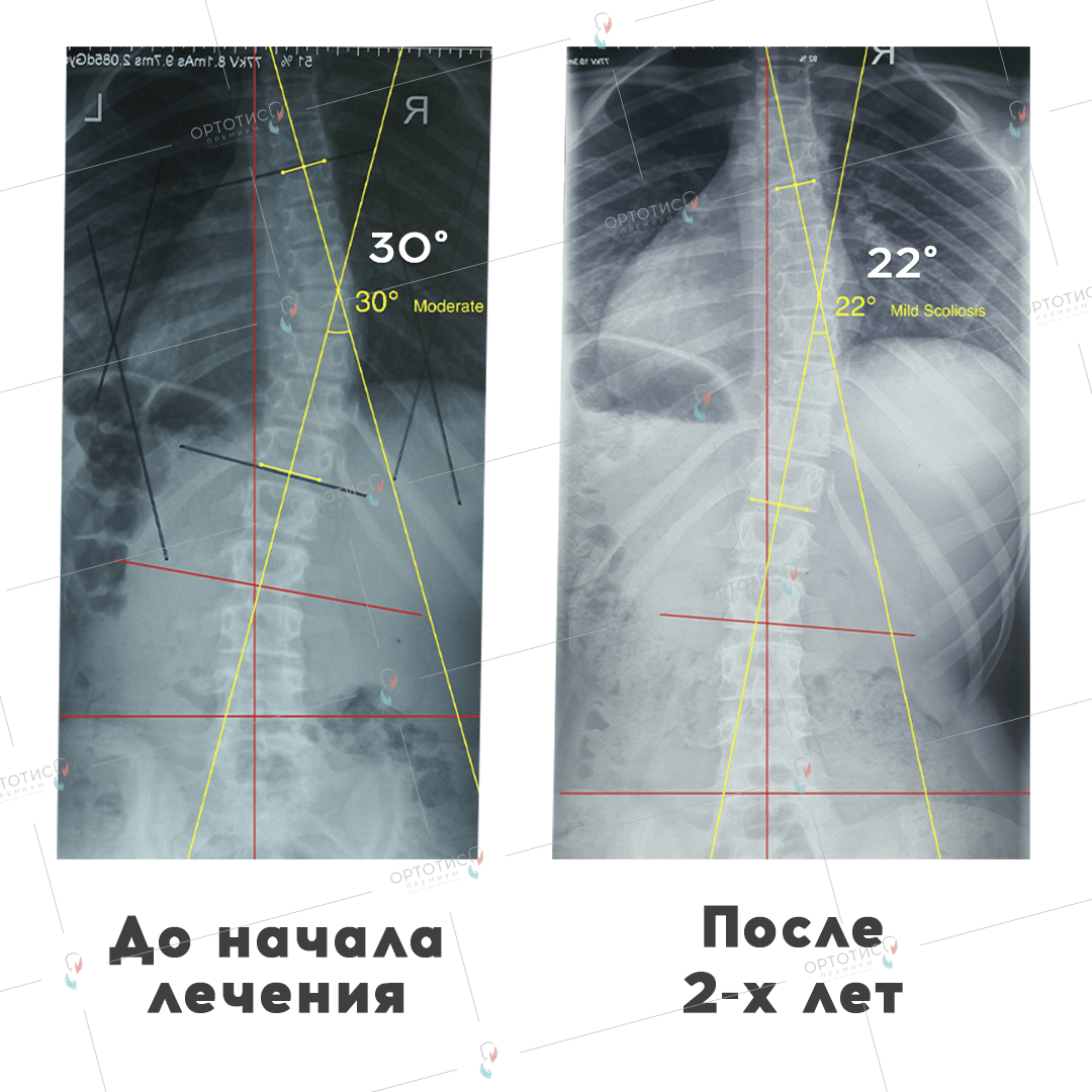 Корсет Шено 3 - Ортотис Премиум