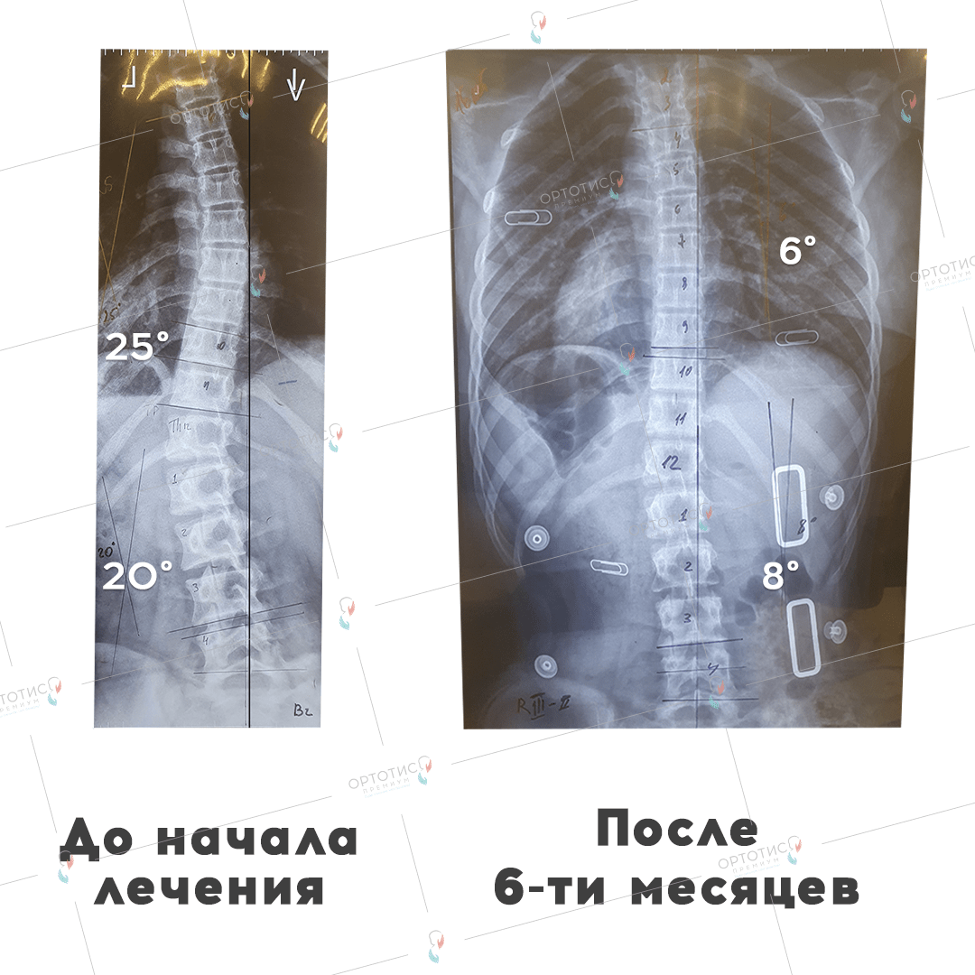 Корсет Шено 15 - Ортотис Премиум