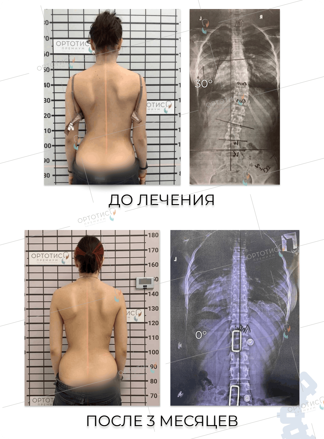 Уменьшение угла сколиоза до и после лечения корсетом Шено
