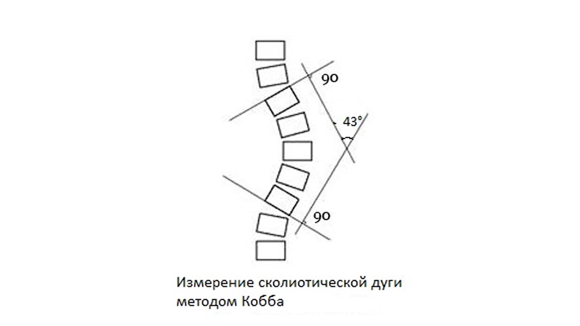Степени сколиоза и угол Кобба